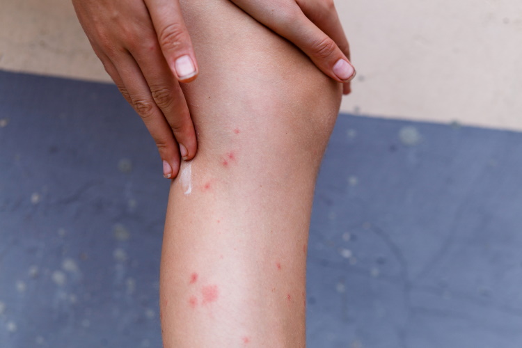 Rubbing Cream Into Mosquito Bites On Legs